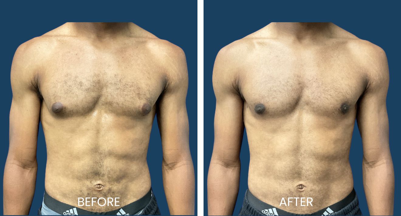 Gynecomastia Before After Plano Plastic Surgery Gynecomastia Before After Plano Plastic Surgery
