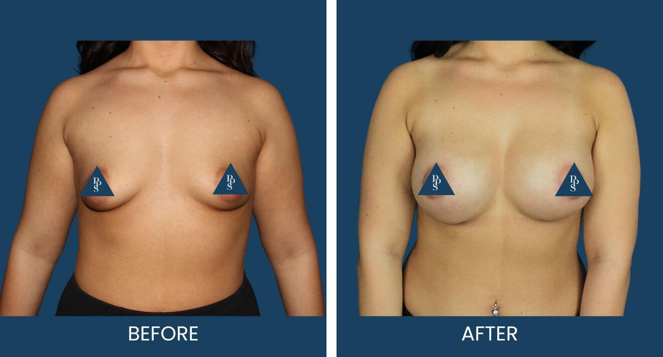 Breast Augmentation (11)