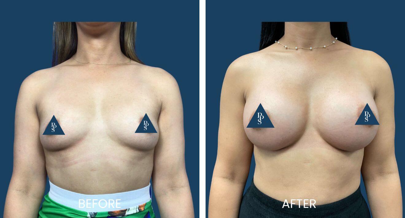 Breast Augmentation (26)