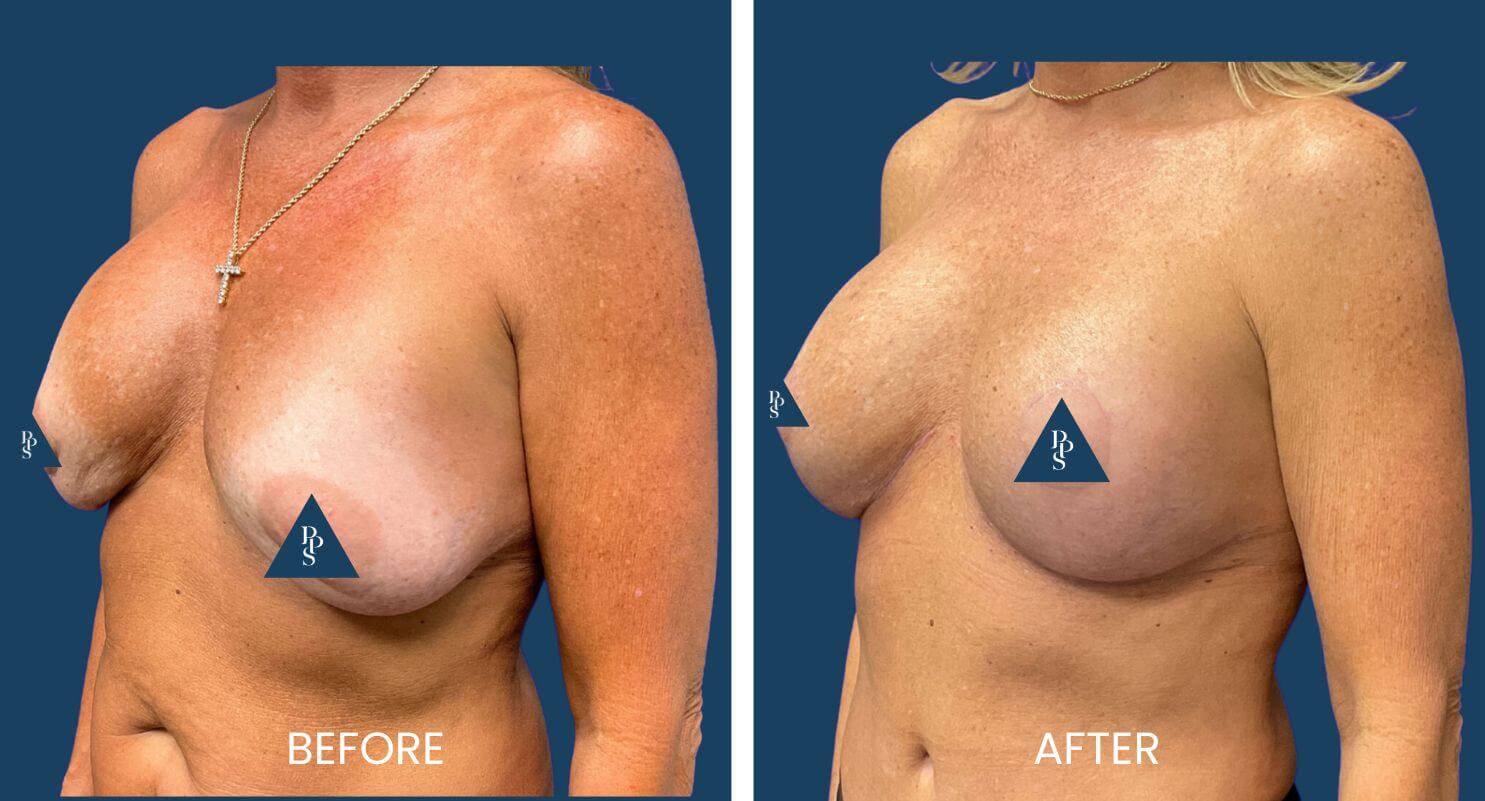 Breast Lift (Mastopexy) with Replacement of Implants (2)
