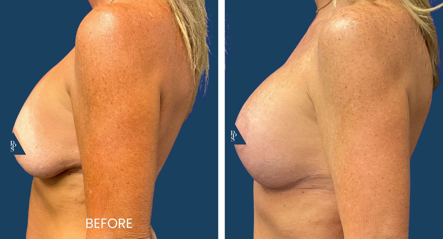 Breast Lift (Mastopexy) with Replacement of Implants