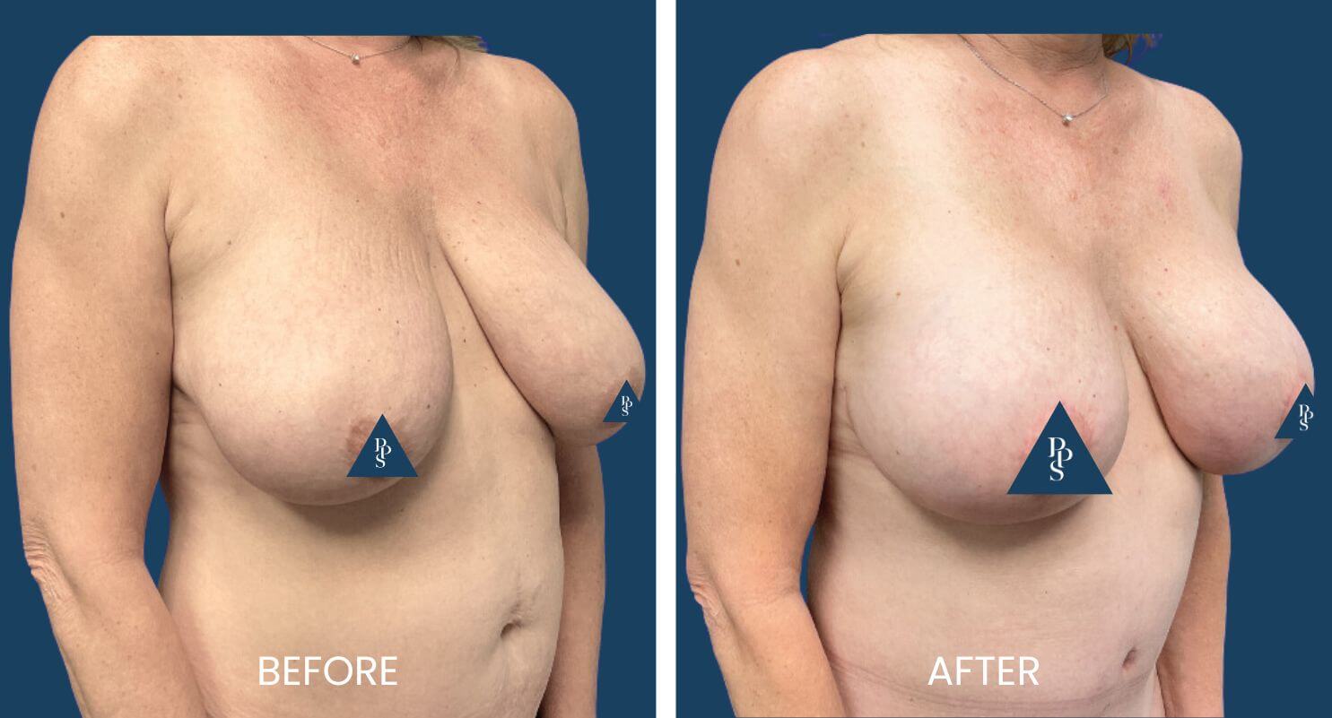 Breast Lift with Implants 2