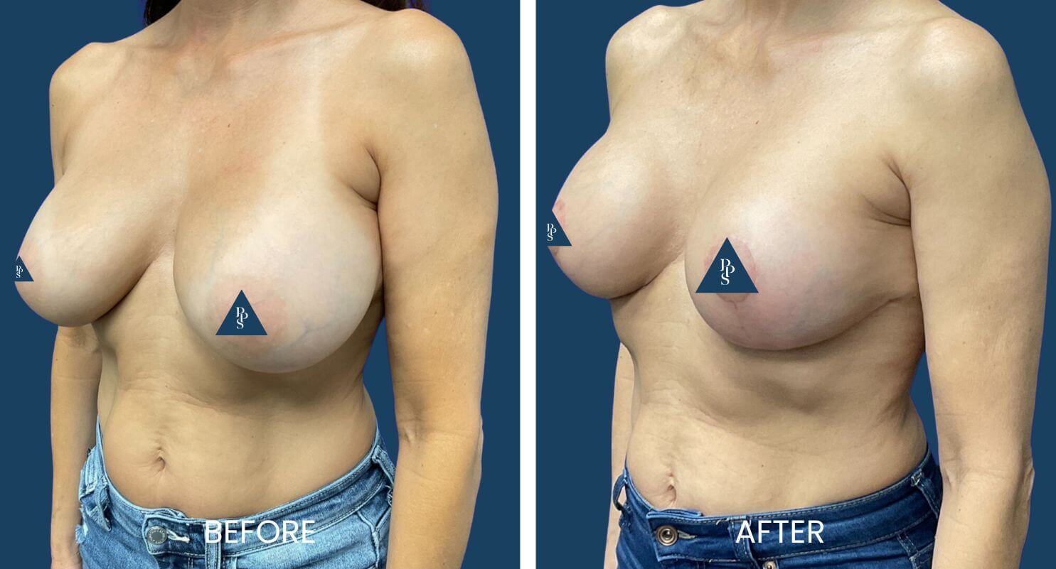 Breast Lift with Replacement of Implants 2