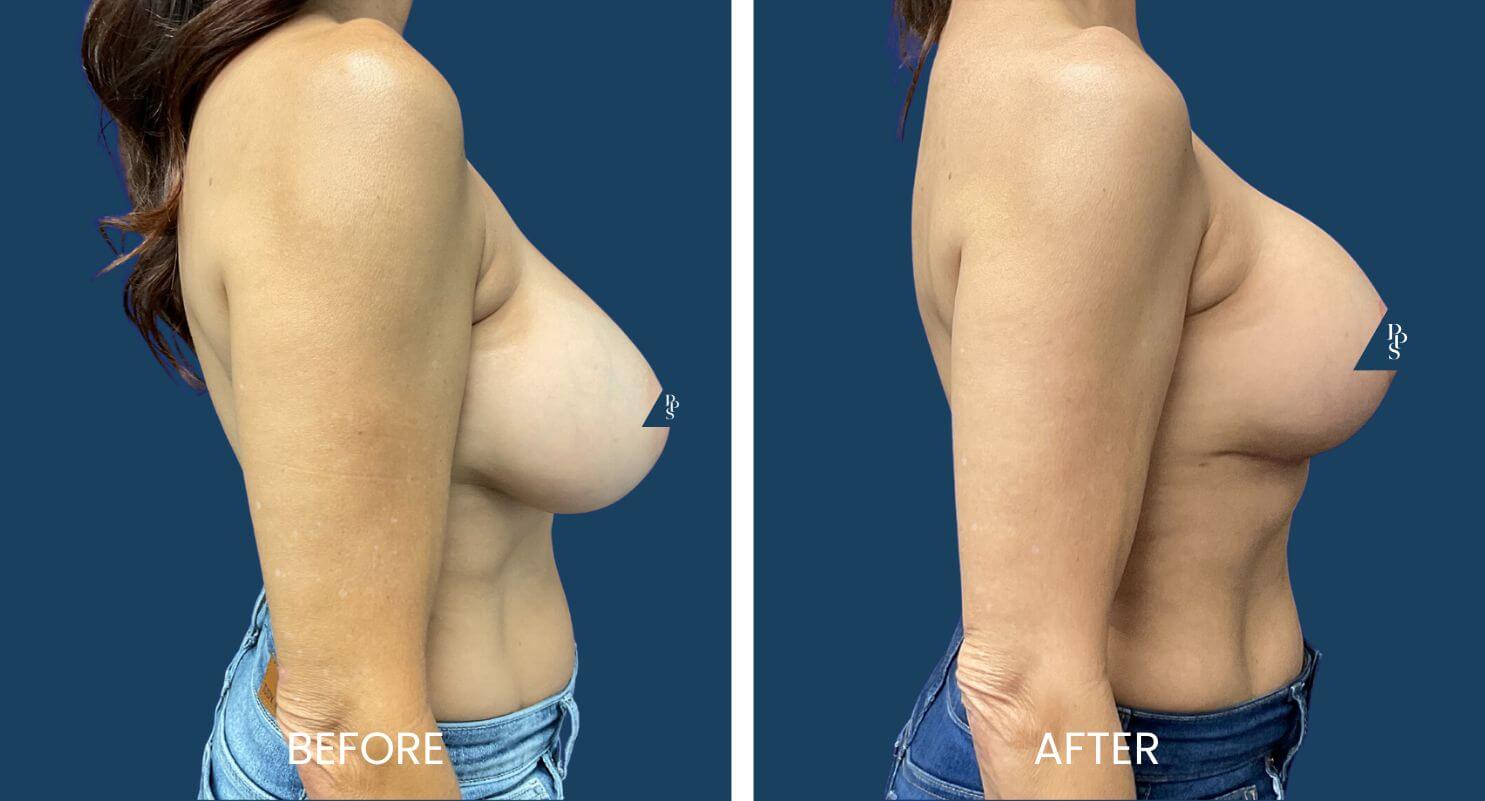 Breast Lift with Replacement of Implants 3