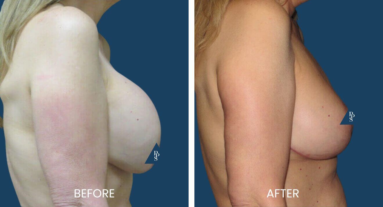 Breast Revision (9)
