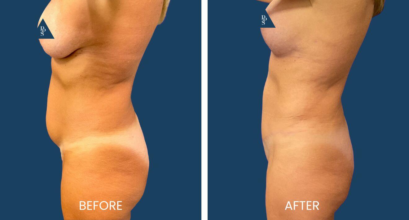 Tummy Tuck and Breast Lift (Mastopexy) with Replacement of Implants (2)