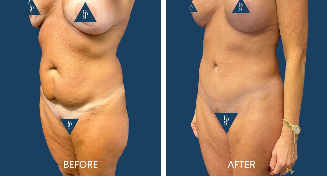 Tummy Tuck and Breast Lift (Mastopexy) with Replacement of Implants (3)