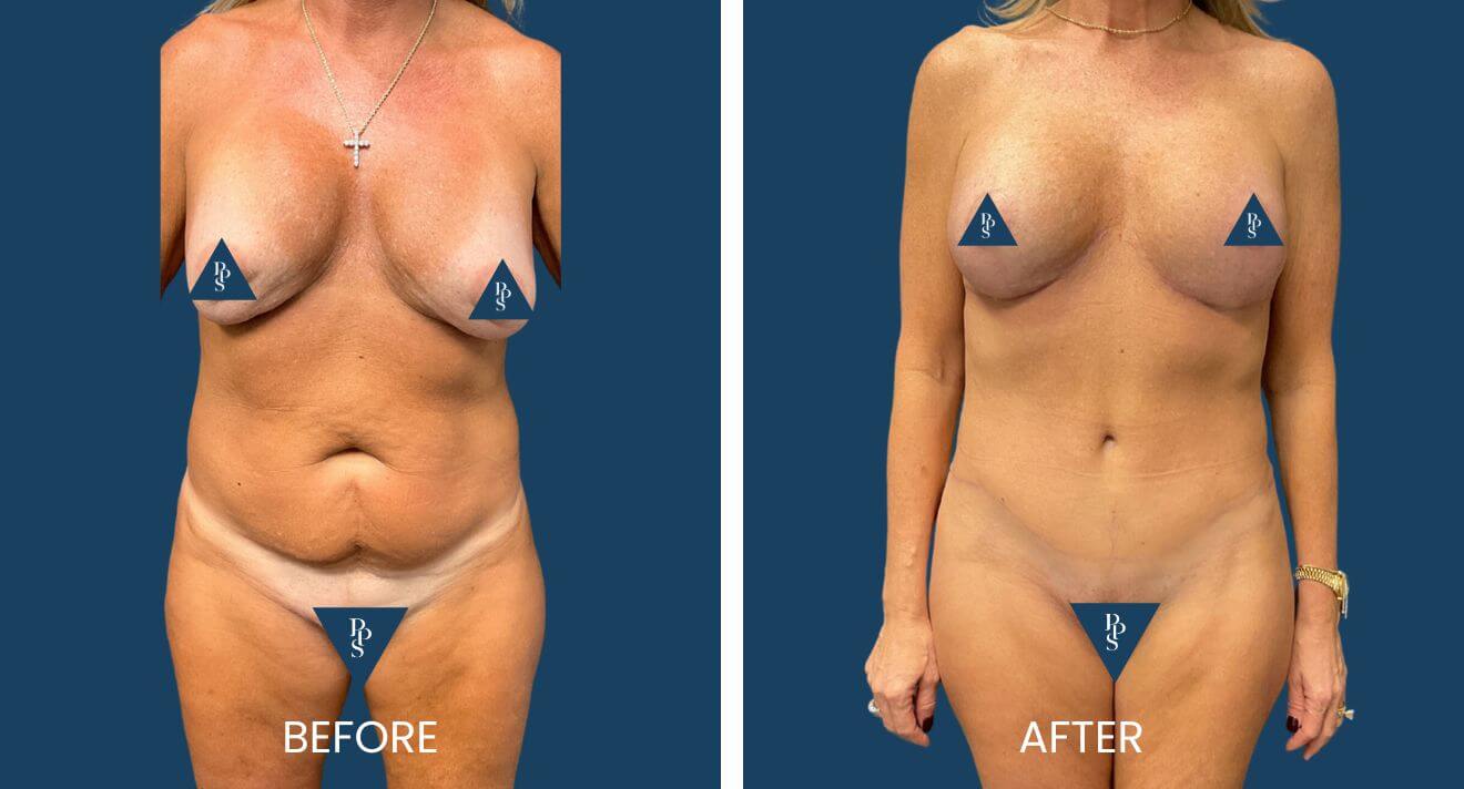 Tummy Tuck and Breast Lift (Mastopexy) with Replacement of Implants (4)