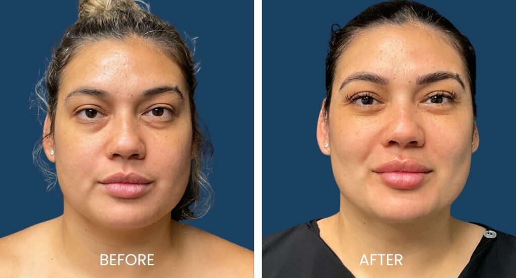 Bichectomy Before and After - Plano Plastic Surgery