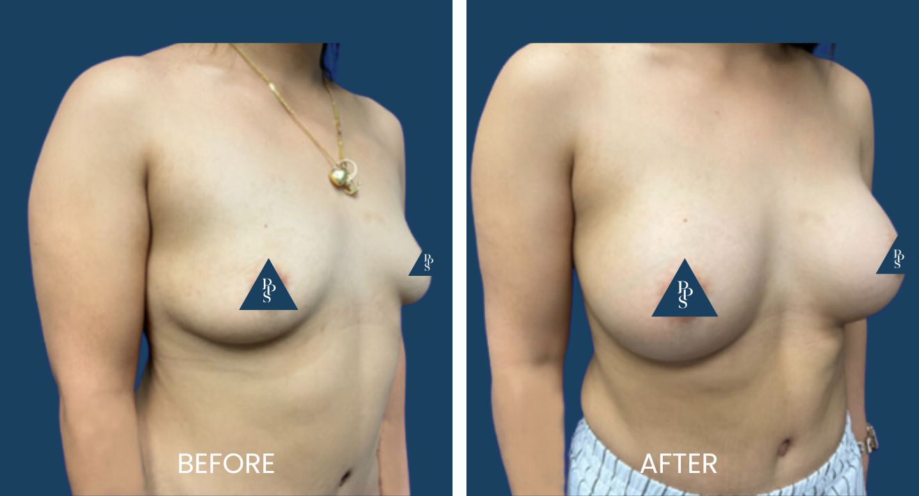 Breast Augmentation (2)