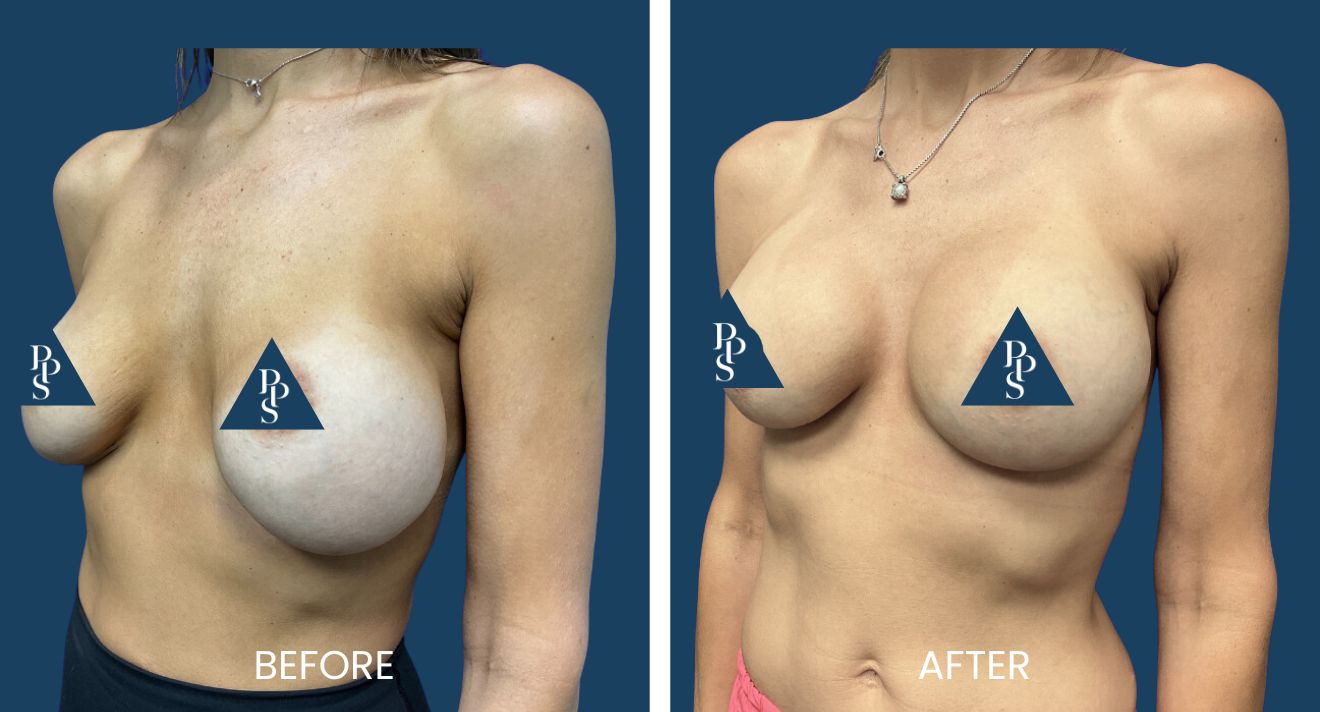 Breast Revision (3)