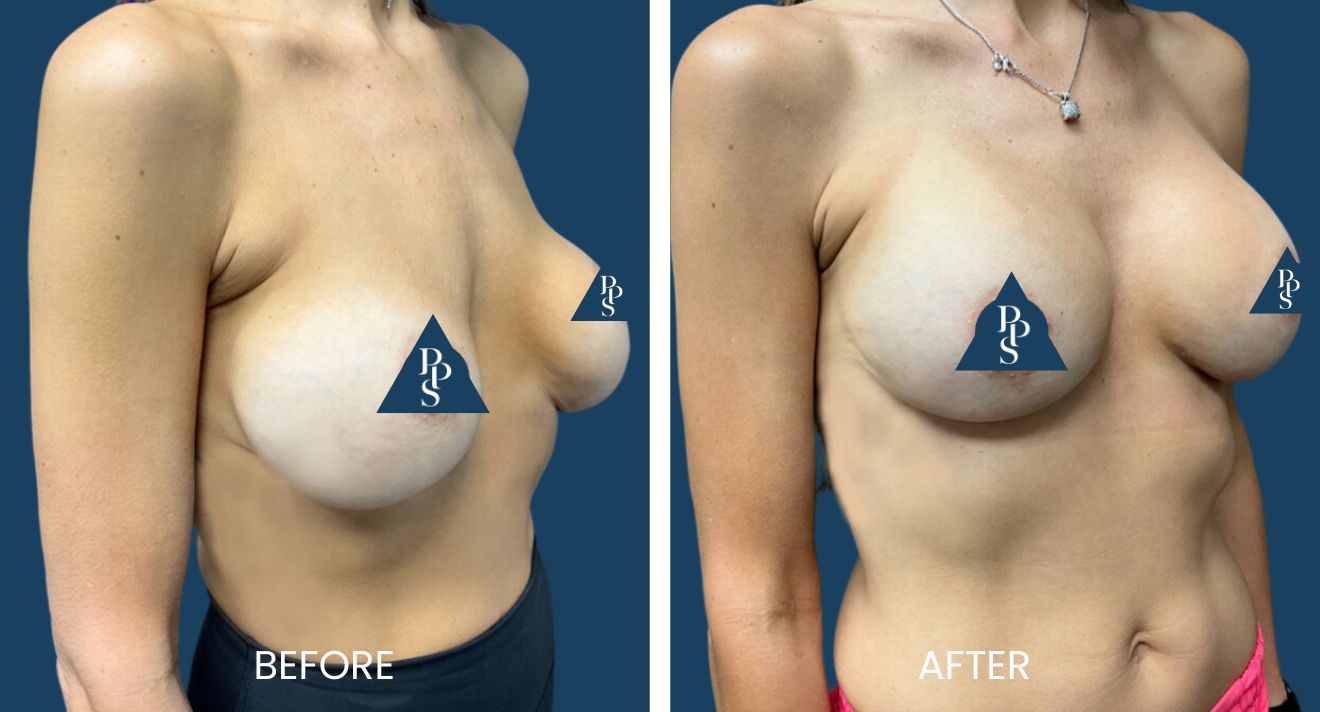 Breast Revision (4)
