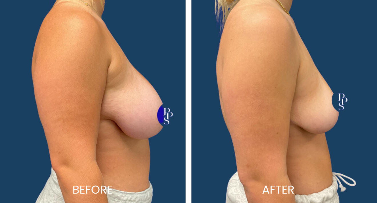 Breast Reduction