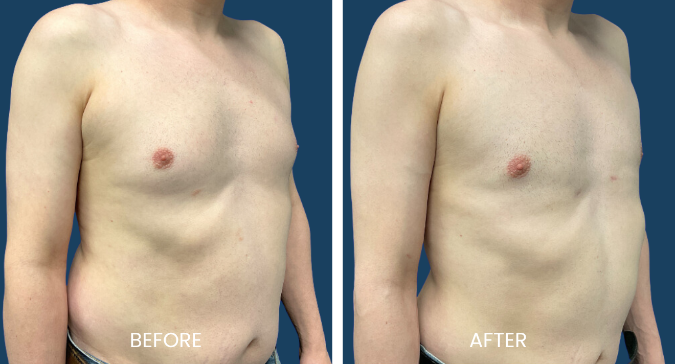 Gynecomastia (2)