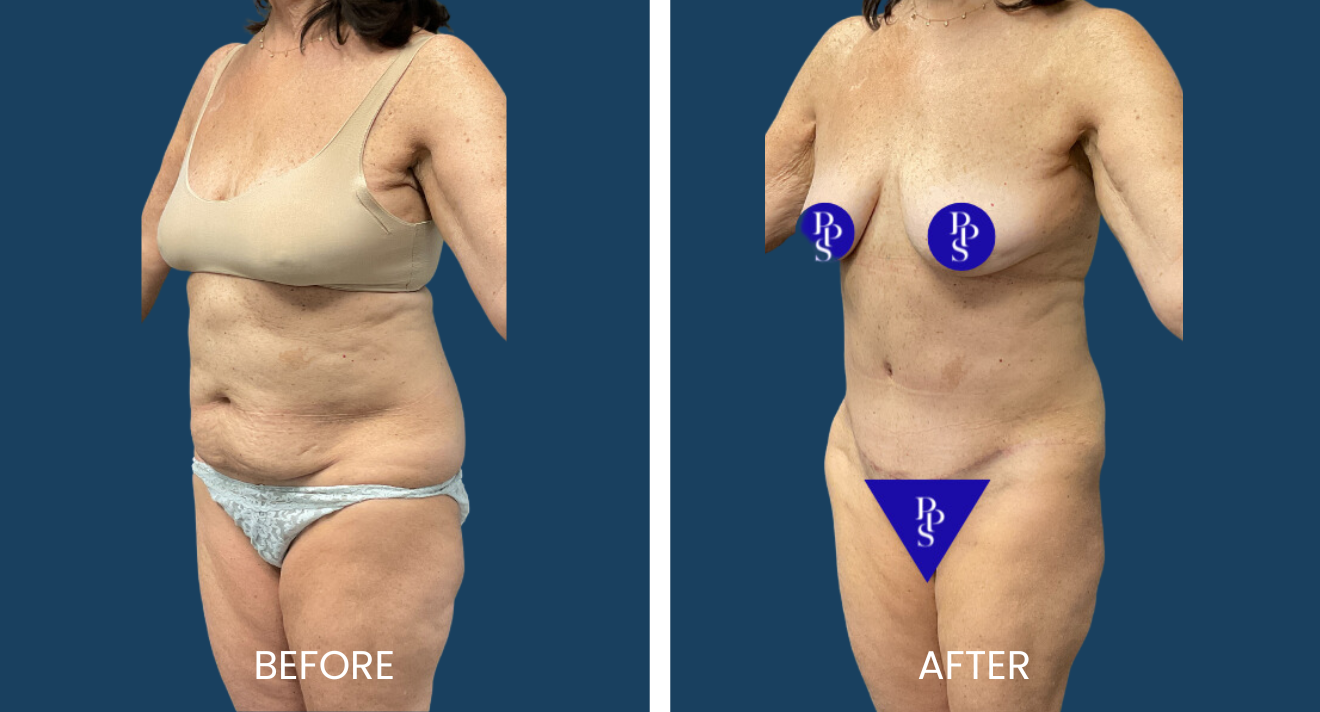 Tummy Tuck (2)