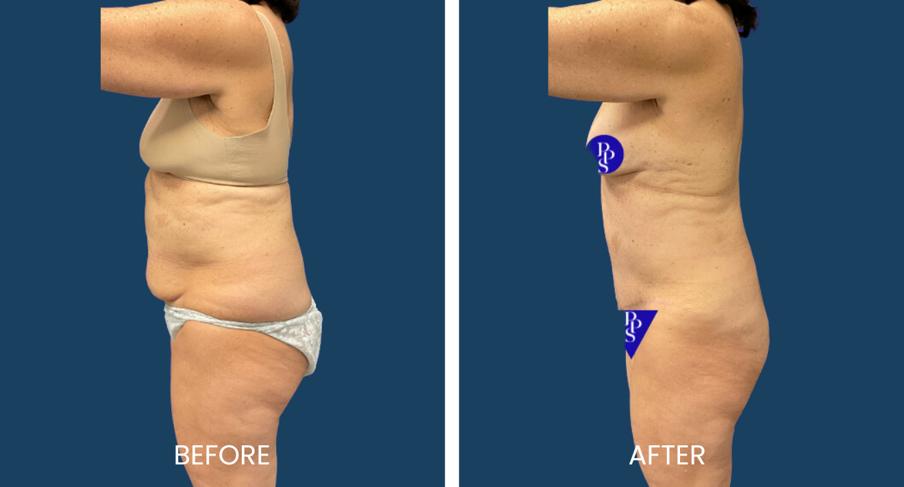 Tummy Tuck