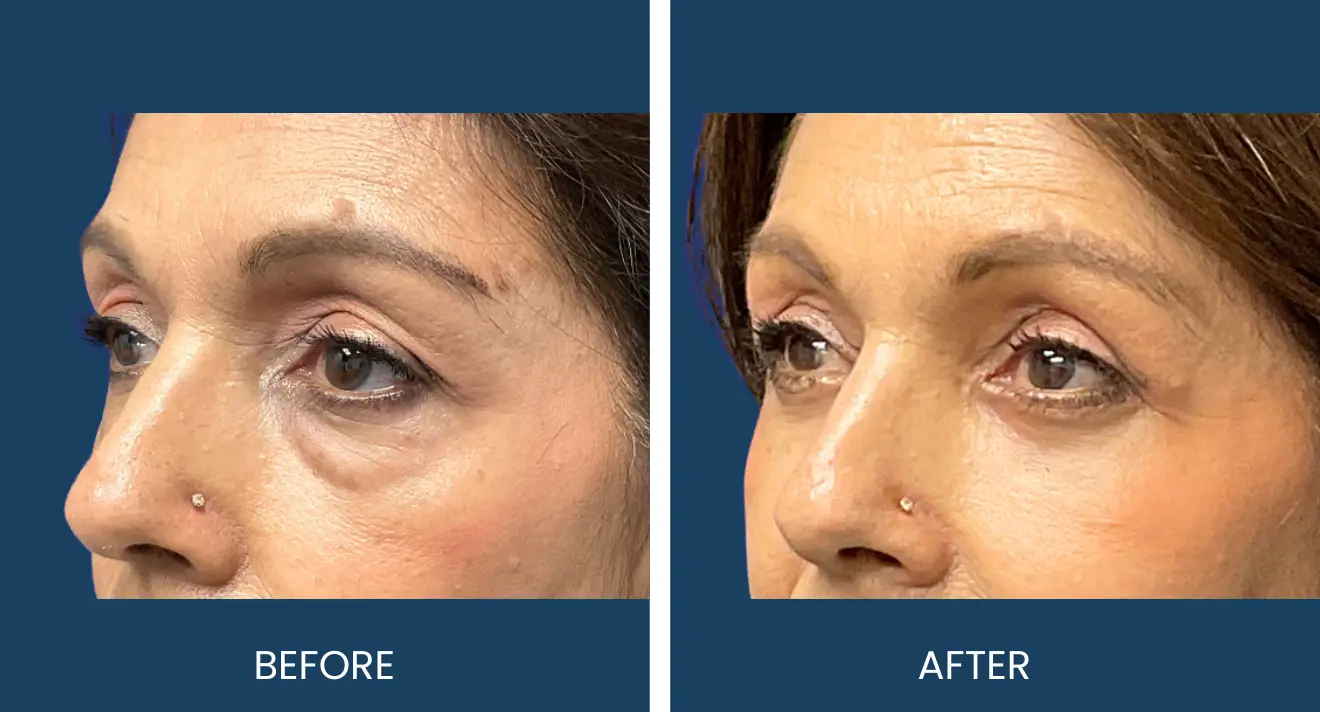 Blepharoplasty (1) (1)