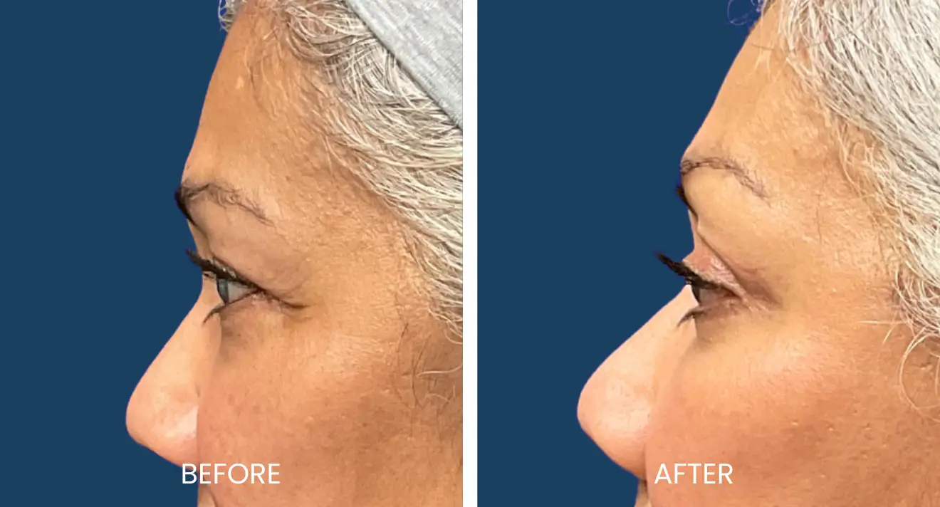 Blepharoplasty