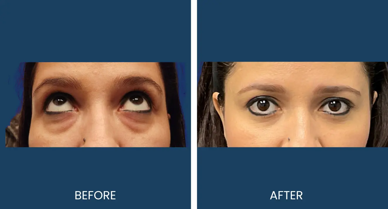 Lower Blepharoplasty (1)