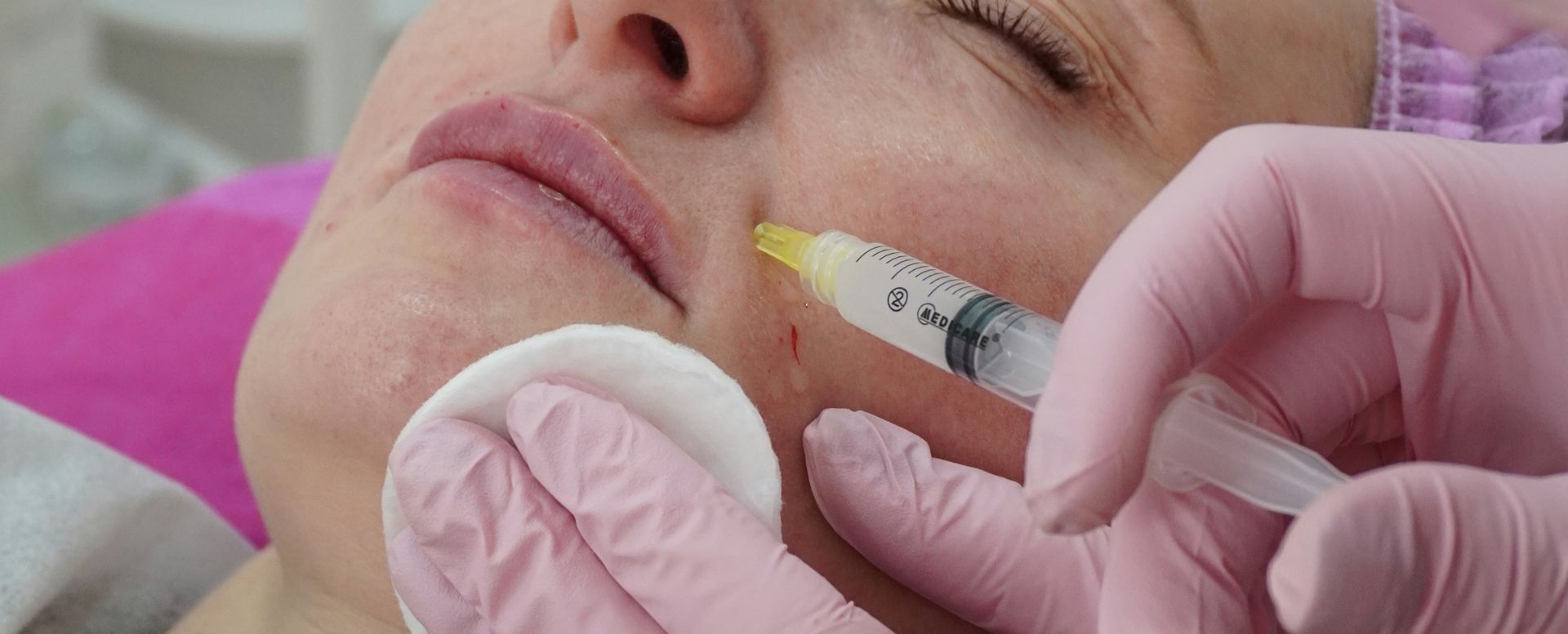 A close-up image of a cosmetic procedure being performed on a woman's face, featuring a professional applying a syringe to inject treatment into her cheek. The practitioner is wearing pink gloves and using a cotton pad to gently hold the skin. This image highlights the process of facial rejuvenation, showcasing the careful techniques used in aesthetic treatments. The setting appears clinical and clean, emphasizing safety and professionalism in cosmetic procedures.