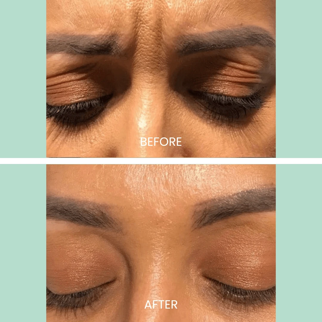 Close-up image showing the effects of a skincare treatment on the area around the eyes. The top half labeled "Before" displays visible wrinkles and fine lines, while the bottom half labeled "After" shows a smoother, more youthful appearance with reduced signs of aging. The image highlights the effectiveness of the treatment in rejuvenating the skin and enhancing overall facial aesthetics. Ideal for demonstrating skincare results in beauty and wellness marketing.