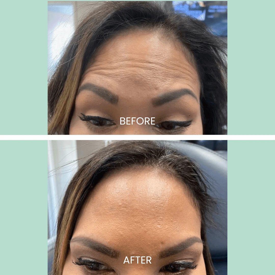 Image showcasing a cosmetic treatment for wrinkle reduction. The top section displays the individual's forehead before the treatment, highlighting visible wrinkles and fine lines. The bottom section illustrates the same individual's forehead after the treatment, showing a smoother and more youthful appearance. The image emphasizes the effectiveness of the procedure in enhancing skin texture and reducing signs of aging. Ideal for those considering cosmetic treatments for rejuvenation.