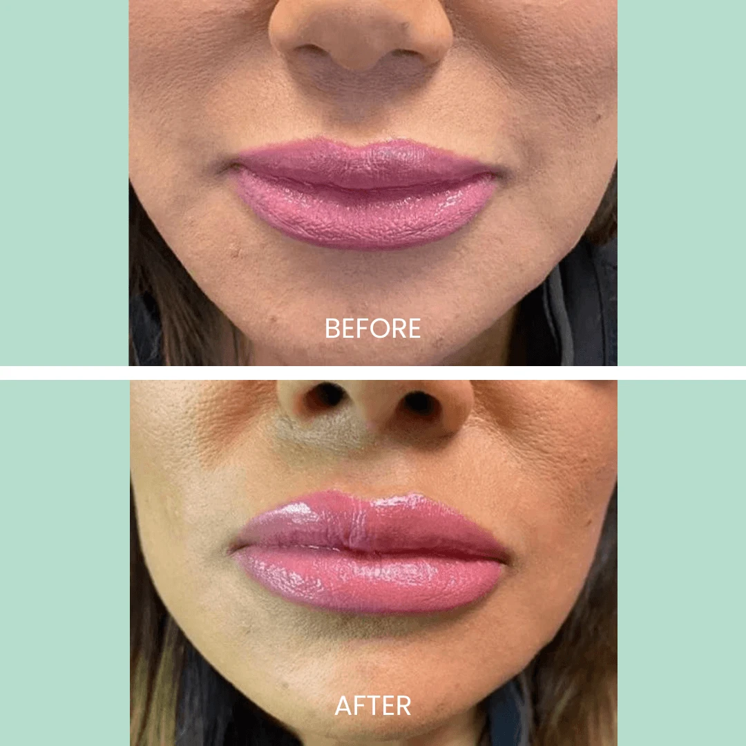 Before and after images showcasing a lip enhancement procedure. The top image displays the lips before treatment, featuring a matte pink lipstick look. The bottom image shows the enhanced lips after the procedure, with a fuller appearance and a glossy finish. Both images emphasize the transformation in lip volume and texture, highlighting the effects of cosmetic lip enhancement. The background is a light green, providing contrast to the lips. This visual representation serves as an informative guide for potential clients considering similar cosmetic treatments.
