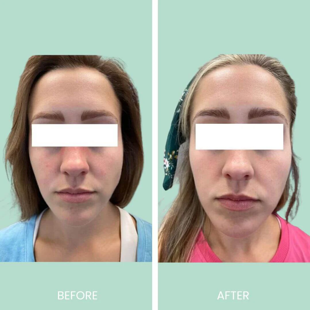 Before and after image showcasing the results of a cosmetic treatment on a woman's face. The left side displays the "before" look, highlighting natural features with minimal makeup, while the right side presents the "after" look, revealing enhanced facial contours and improved skin tone. The woman is wearing different colored tops in each photo, with a noticeable difference in her overall appearance, suggesting a successful transformation. The background is a soft green, emphasizing the subject. This image highlights the effectiveness of cosmetic procedures in enhancing beauty