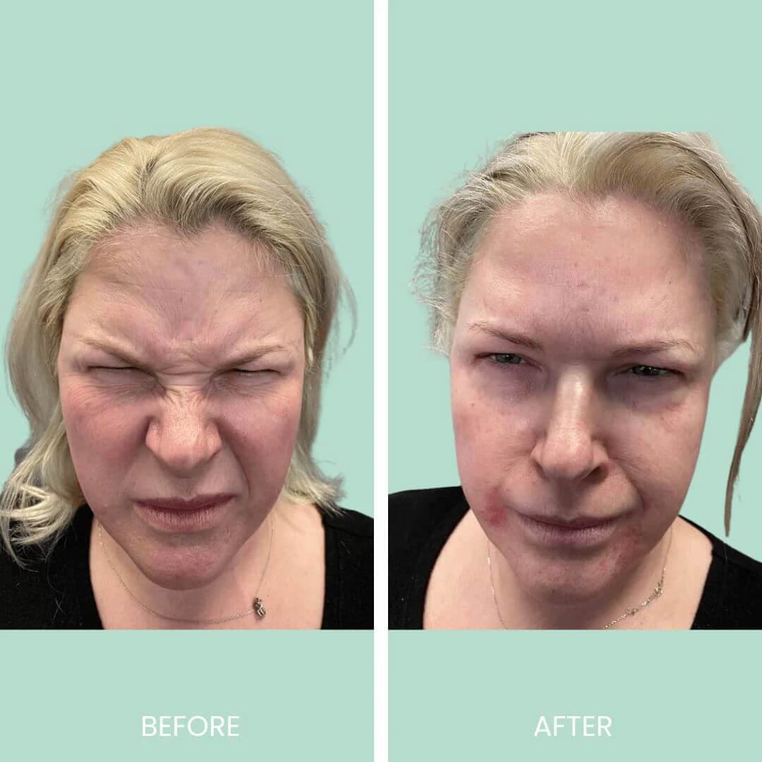Image comparison showcasing facial transformation before and after a cosmetic procedure. The left side displays a woman with a scrunched facial expression, highlighting signs of tension and skin imperfections. The right side shows the same woman with a relaxed expression, indicating improved skin texture and appearance post-treatment. The background is a soft green, enhancing the visual contrast between the two images labeled "BEFORE" and "AFTER." This image illustrates the effectiveness of cosmetic interventions in enhancing facial aesthetics.