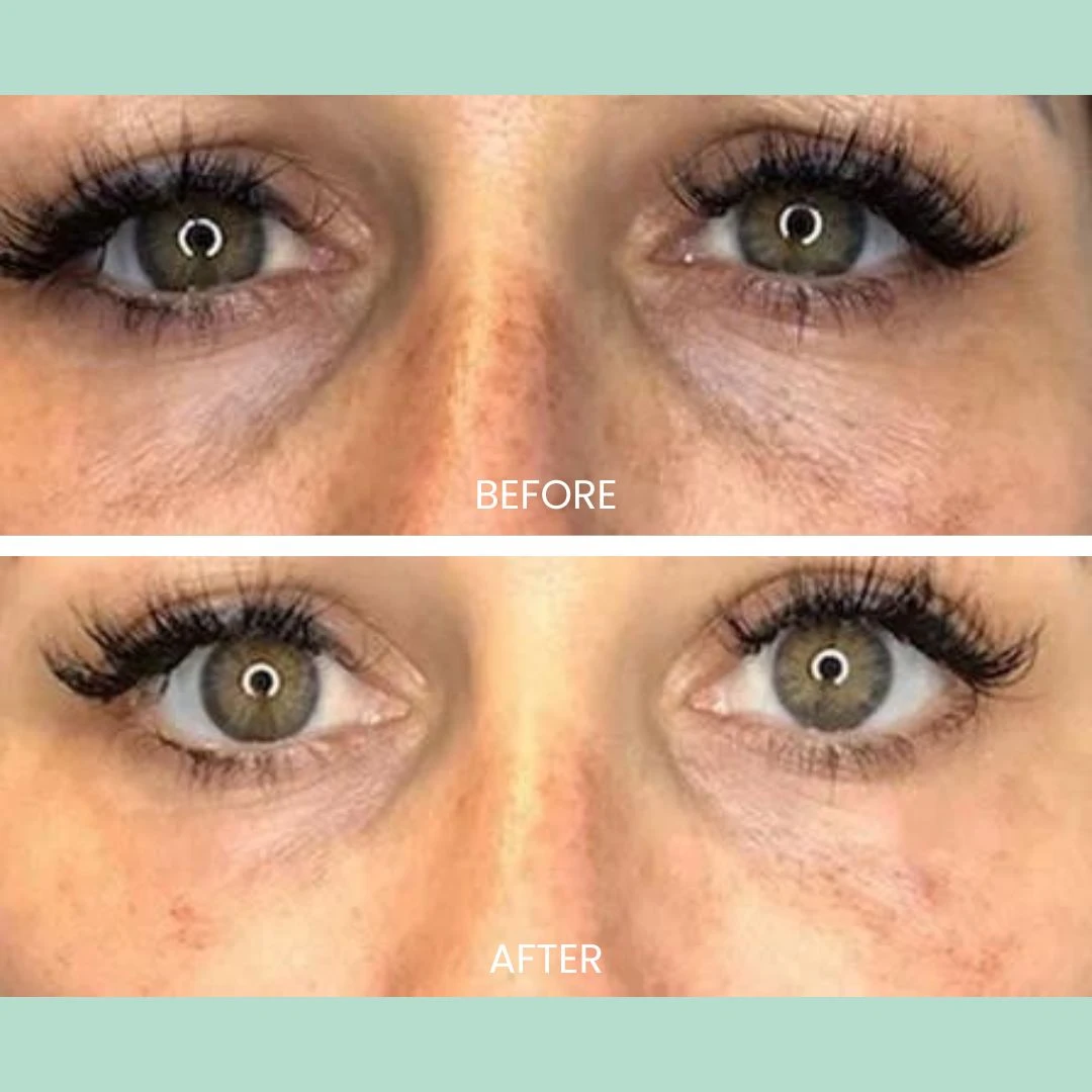 Before-and-after comparison of eye appearance, highlighting improvements in skin texture and tone. The top section labeled "Before" shows noticeable dark circles and fine lines around the eyes, while the bottom section labeled "After" displays a smoother, brighter look with reduced imperfections. This image illustrates the effectiveness of skincare treatments or cosmetic procedures aimed at rejuvenating the eye area, promoting a more youthful and refreshed appearance. Ideal for skincare marketing and educational content related to beauty treatments.
