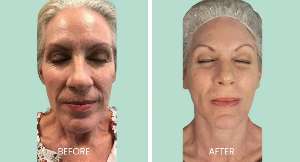 Before and after images of a woman's face showcasing the results of a cosmetic treatment. The left side labeled "Before" displays visible signs of aging, including wrinkles and sagging skin. The right side labeled "After" highlights a smoother, more youthful appearance with reduced wrinkles and improved skin texture. Both images have a light green background, emphasizing the transformation. The woman has her eyes closed in both photos, wearing a hair covering in the after image. This visual comparison illustrates the effectiveness of the treatment in enhancing