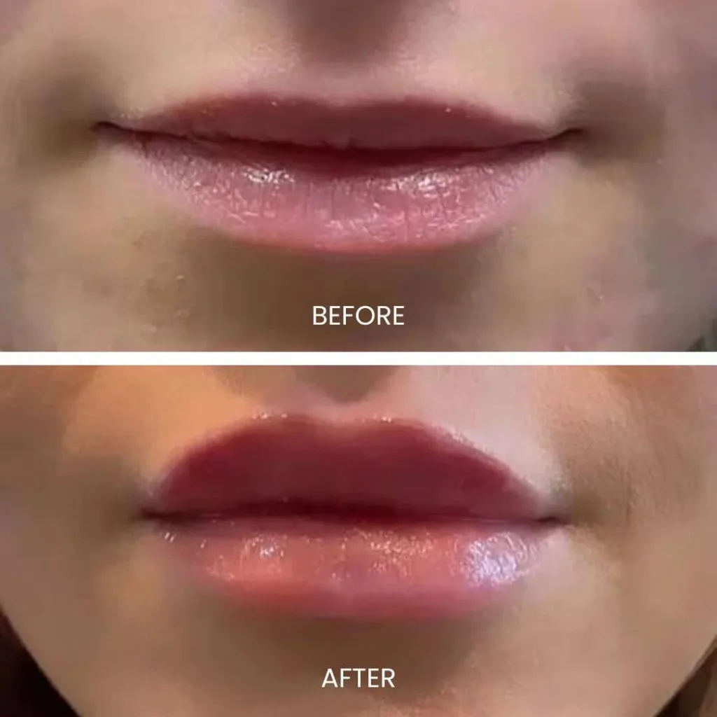 Before and after images showcasing lip enhancement results. The top section displays natural lips with a subtle appearance, labeled "Before," while the bottom section features fuller, more defined lips, labeled "After." This visual comparison highlights the transformation achieved through cosmetic procedures, emphasizing the aesthetic improvement in lip volume and shape. Ideal for those considering cosmetic lip enhancements or seeking inspiration for beauty treatments.