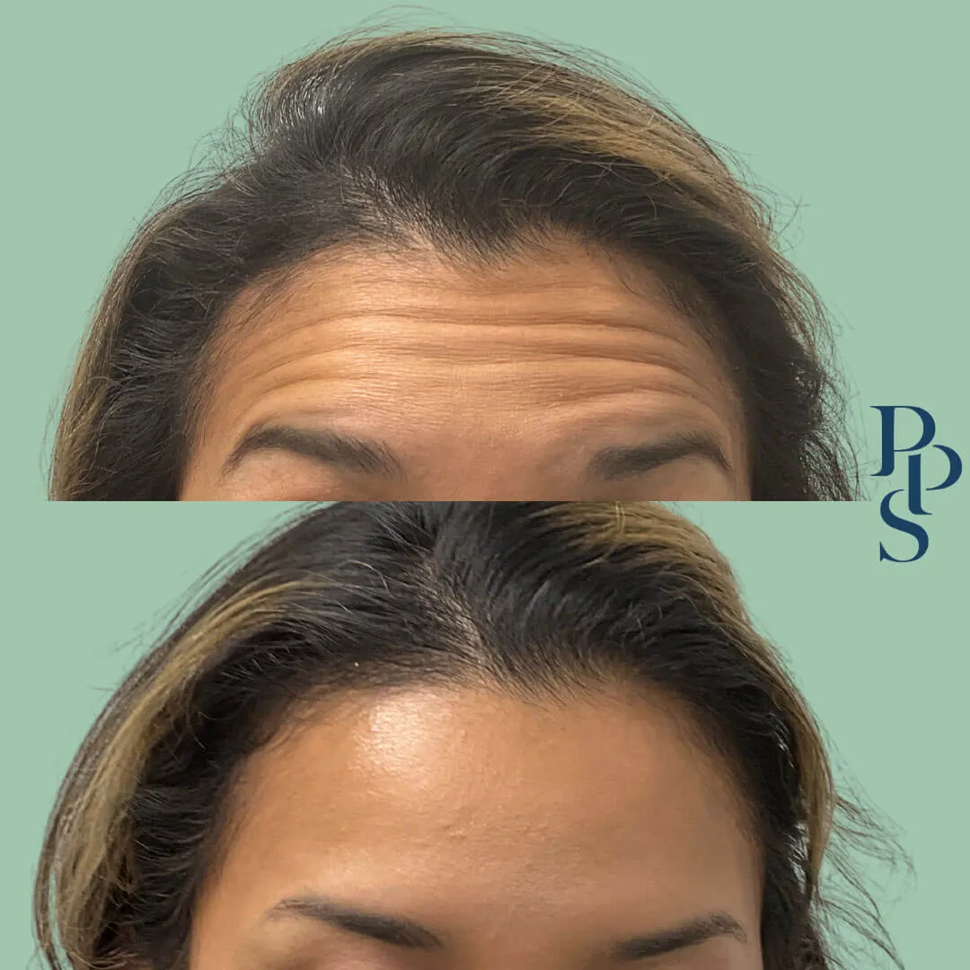 Before and after images showcasing the effects of a cosmetic treatment on forehead wrinkles. The top image displays pronounced forehead lines, while the bottom image shows a smoother, wrinkle-free forehead. The background is a soft green, providing contrast to the subject. This visual comparison highlights the effectiveness of the treatment in reducing signs of aging, appealing to individuals seeking cosmetic improvements.