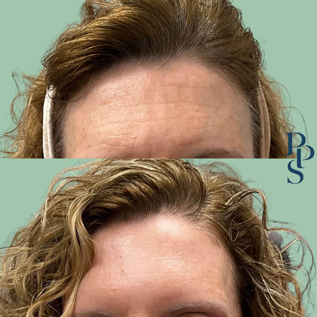 Before and after image showcasing the forehead area of a woman who underwent a cosmetic procedure. The top image displays visible forehead wrinkles and fine lines, while the bottom image shows a smoother, more youthful appearance with reduced signs of aging. The woman's hair is styled in loose curls, and she is wearing a headband, with a neutral background. This transformation highlights the effectiveness of the treatment in enhancing skin texture and reducing wrinkles. Ideal for individuals considering cosmetic solutions for aging skin.