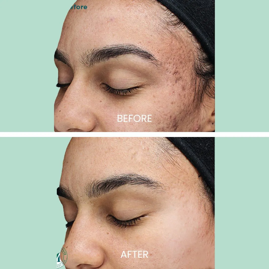 Before and after image showcasing a facial treatment. The top half displays the "before" condition with visible acne scars and uneven skin texture, while the bottom half illustrates the "after" results, revealing smoother skin and reduced imperfections. Both images are taken from a side profile perspective, highlighting the improvement in skin clarity and overall appearance. This visual comparison emphasizes the effectiveness of the treatment in enhancing skin health and aesthetics.