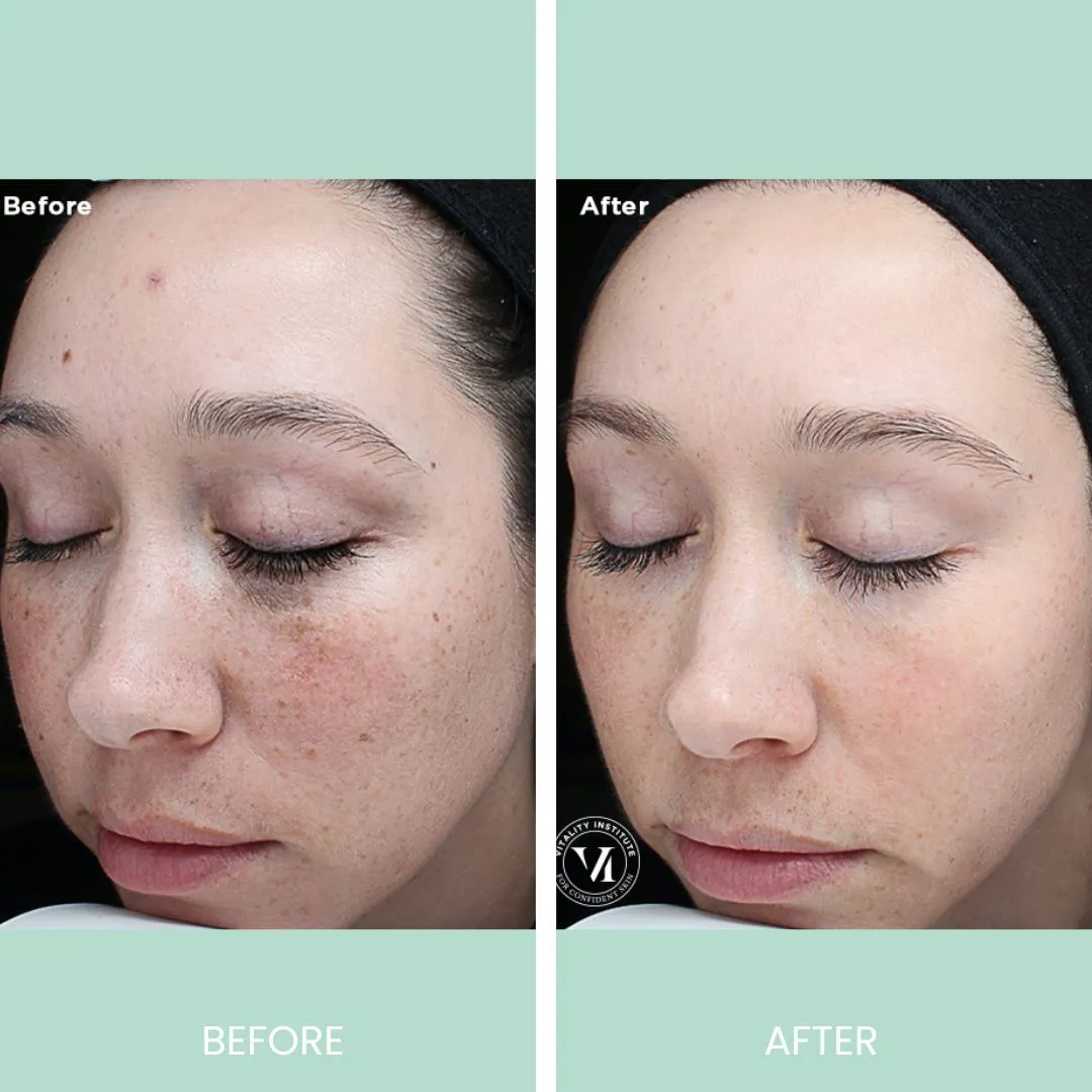 Before and after image showcasing a skincare treatment. The left side displays the "before" condition, highlighting uneven skin tone and visible freckles. The right side shows the "after" result, demonstrating improved skin clarity and reduced pigmentation. The subject has closed eyes and is facing slightly to the side, emphasizing the transformation in skin appearance. This image illustrates the effectiveness of the skincare regimen used, appealing to potential customers seeking similar results.