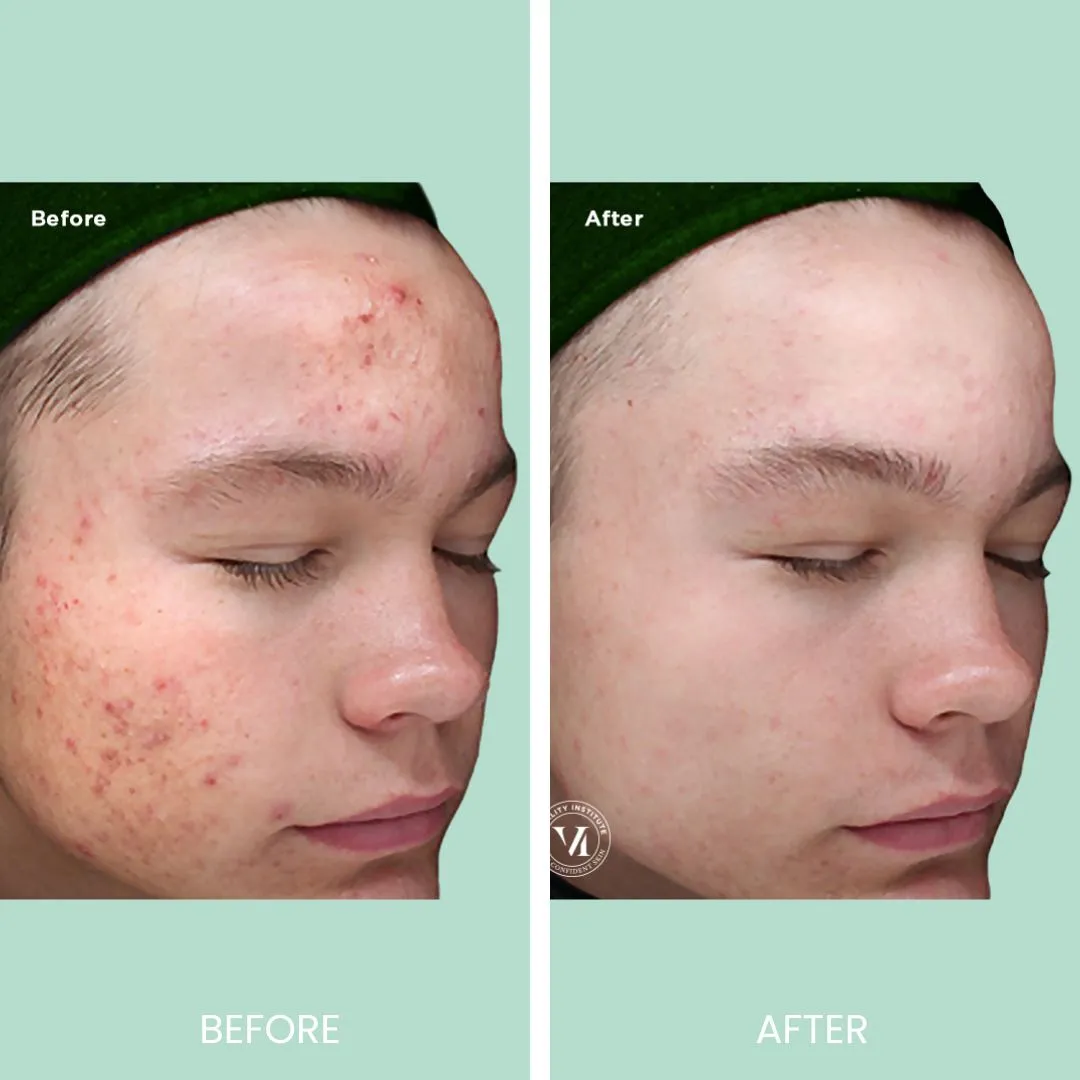 Before and after images showing a male subject's facial skin improvement. The left side displays the "Before" condition with noticeable acne and blemishes on the forehead and cheeks. The right side shows the "After" result, highlighting clearer skin with significantly reduced acne and improved texture. Both images feature the subject with eyes closed, emphasizing the transformation achieved through skincare treatment. The background is a soft green, enhancing the visual appeal of the comparison.