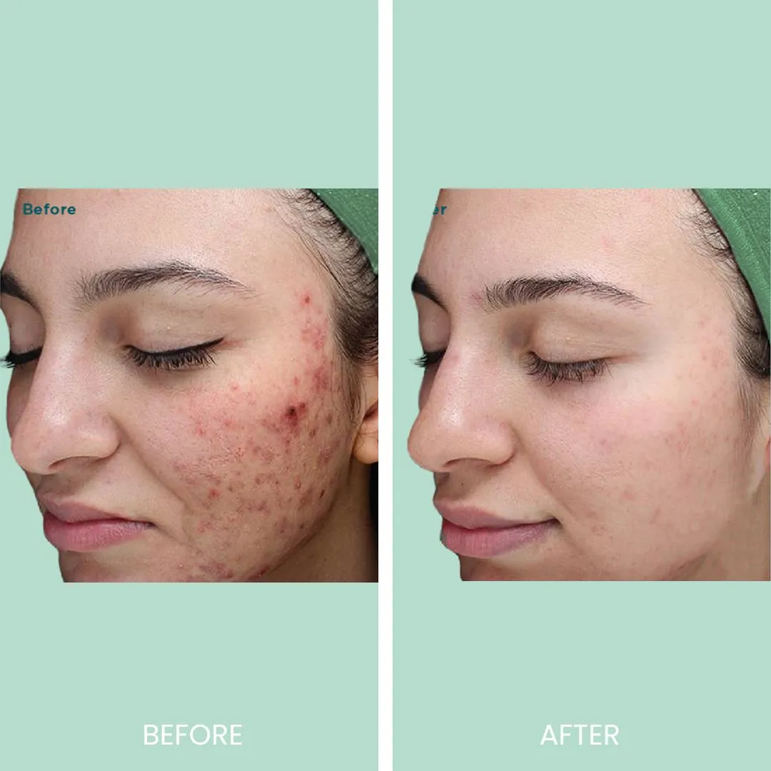 Before and after image showcasing the transformation of a woman's skin. The left side displays the "before" condition with visible acne and redness on the cheek, while the right side shows the "after" result with clearer, smoother skin. Both images highlight the effectiveness of skincare treatments. The background is a soft green, enhancing the focus on the skin's improvement. This visual serves as a testament to successful acne treatment and skin rejuvenation.