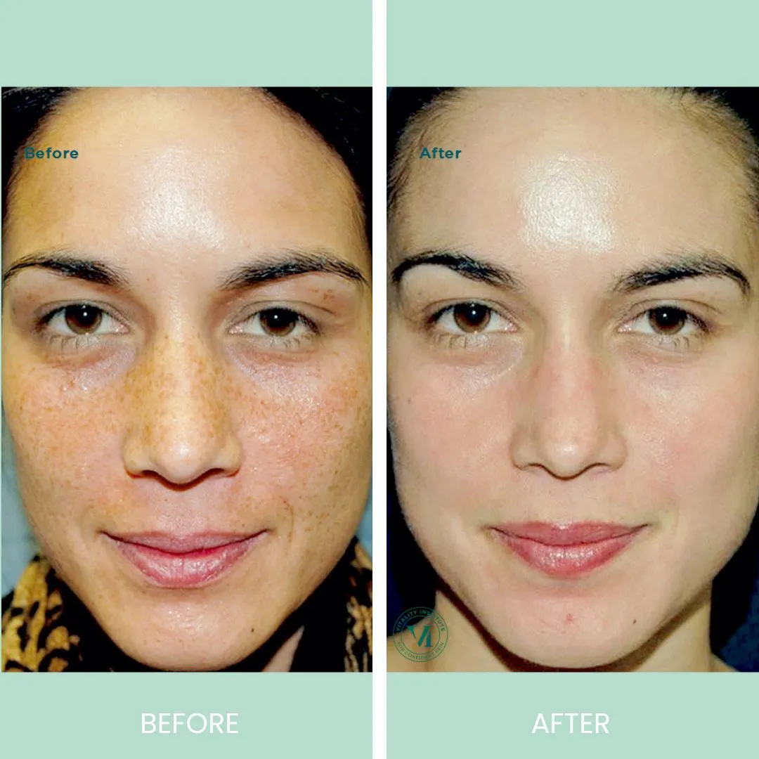 Before and after image showcasing facial skin treatment results. The left side displays the "before" condition with visible freckles and uneven skin tone, while the right side presents the "after" result, highlighting a smoother and more even complexion. Both images emphasize improvements in skin appearance, illustrating the effectiveness of the treatment. Ideal for demonstrating skincare solutions and their positive impact on skin health.