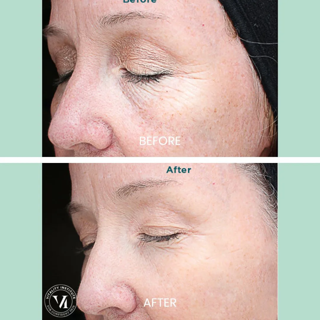 Before and after images showcasing the results of a skincare treatment on a woman's face. The top image labeled "Before" displays visible signs of aging, including fine lines and uneven skin texture. The bottom image labeled "After" illustrates significant improvement in skin smoothness and reduction of wrinkles, highlighting a more youthful appearance. The background is a soft green, enhancing the focus on the skin's transformation. This visual representation emphasizes the effectiveness of the treatment in rejuvenating skin health and appearance.