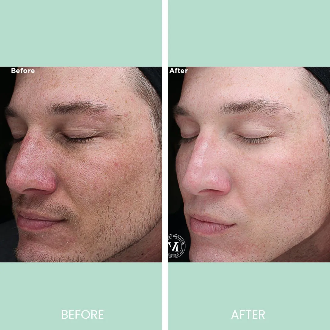 Before and after image comparison showing the results of a facial treatment on a male model. The left side displays the "before" condition with visible skin imperfections, redness, and uneven texture. The right side shows the "after" result, highlighting smoother skin, reduced redness, and a more even complexion. This transformation demonstrates the effectiveness of the skincare treatment, emphasizing improved skin clarity and overall appearance. Ideal for showcasing skincare results in promotional materials or social media.