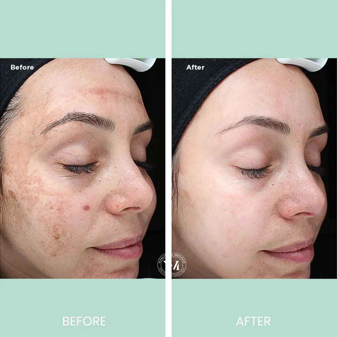 Before and after image showcasing the results of a skincare treatment on a woman's face. The left side labeled "Before" displays visible skin concerns such as dark spots and uneven texture. The right side labeled "After" shows significant improvement with clearer, smoother skin. Both images highlight the transformation achieved through the treatment, emphasizing the effectiveness of skincare solutions for enhancing skin appearance and promoting confidence.