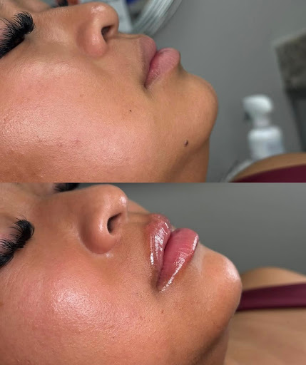 Before and after image showcasing the results of a lip enhancement procedure. The top half displays the natural lip appearance, while the bottom half illustrates fuller, more defined lips post-treatment. The subject has a smooth complexion and is positioned in a well-lit setting, highlighting the effects of the enhancement. This image emphasizes the aesthetic transformation achieved through cosmetic procedures, appealing to individuals interested in beauty treatments.