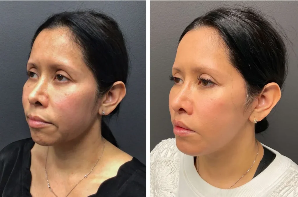 Before and after images showcasing a woman's facial profile transformation. The left side displays her appearance prior to treatment, highlighting subtle signs of aging and skin texture. The right side illustrates her refreshed look post-treatment, emphasizing improved skin smoothness and contour. Both images are set against a neutral background, allowing for clear visibility of the facial changes. This visual comparison serves as an informative reference for individuals considering similar aesthetic procedures.