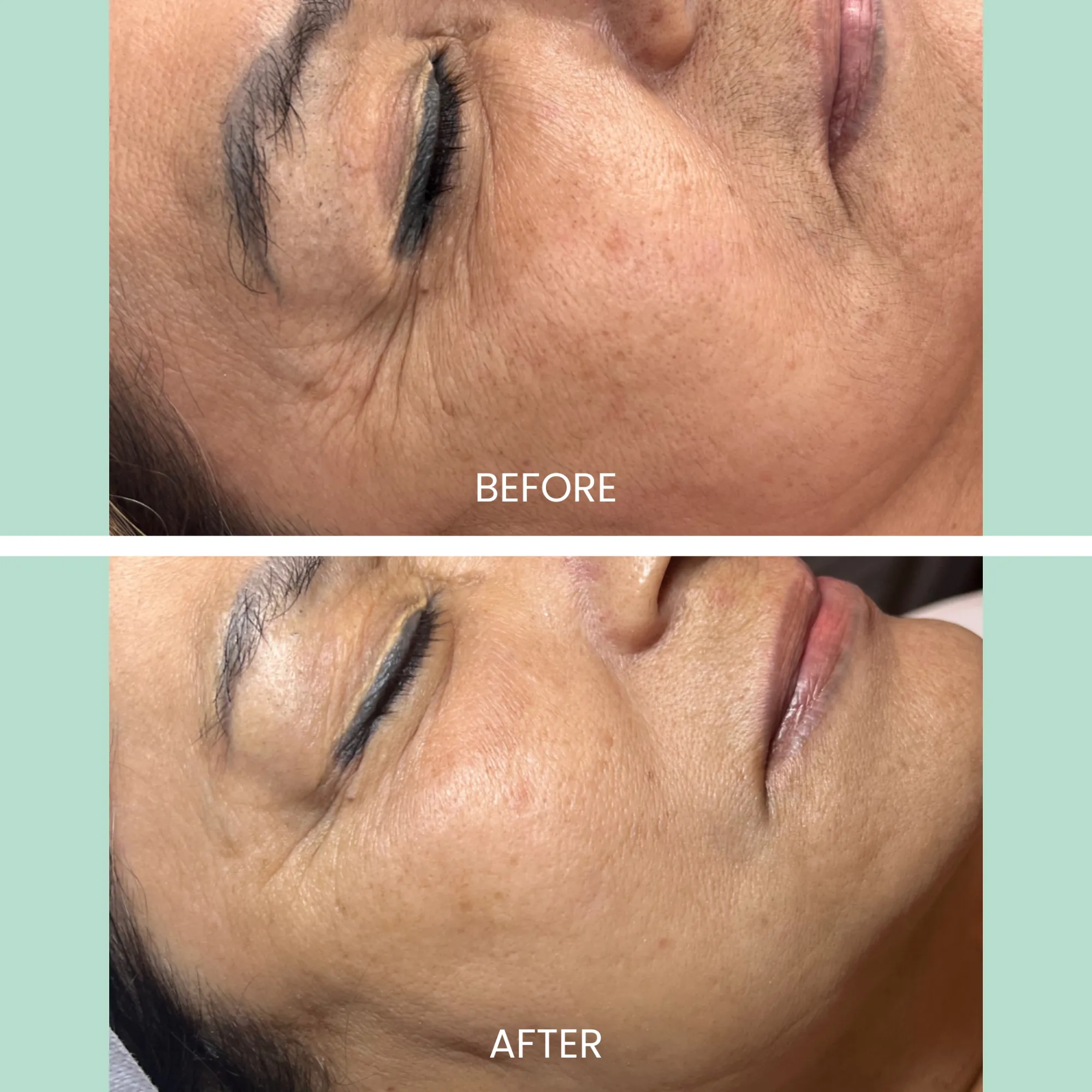 Before and after image showcasing facial rejuvenation results. The top half displays the "before" condition with visible wrinkles, fine lines, and uneven skin texture around the eyes and cheeks. The bottom half illustrates the "after" results, highlighting smoother skin, reduced wrinkles, and a more youthful appearance. This transformation emphasizes the effectiveness of skincare treatments in enhancing facial aesthetics. Ideal for demonstrating the benefits of anti-aging procedures or skincare products.