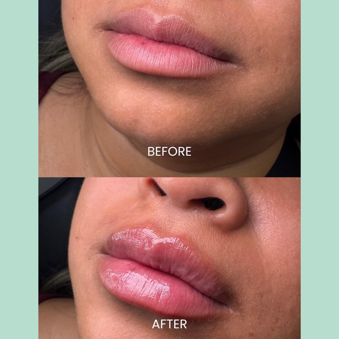 Close-up comparison of a person's lips, showcasing the transformation from a natural, unenhanced look labeled "Before" to a fuller, glossy appearance labeled "After." The top image displays the lips with a matte finish, while the bottom image features enhanced, hydrated lips, reflecting the results of a cosmetic treatment. The background is a soft green, providing contrast to the images. This visual highlights the effectiveness of lip enhancement procedures, appealing to potential clients interested in cosmetic improvements.