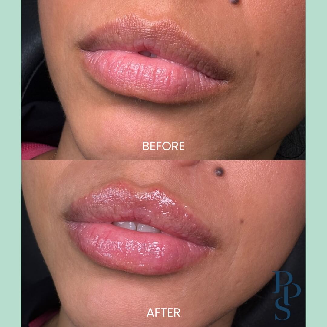 Before and after image showcasing lip enhancement results. The top section displays the original lip appearance with a natural, matte finish, while the bottom section reveals a fuller, glossy look achieved through cosmetic procedures. The image highlights the transformation in lip volume and hydration, emphasizing the effectiveness of the treatment. This visual comparison is ideal for potential clients seeking lip enhancement options.