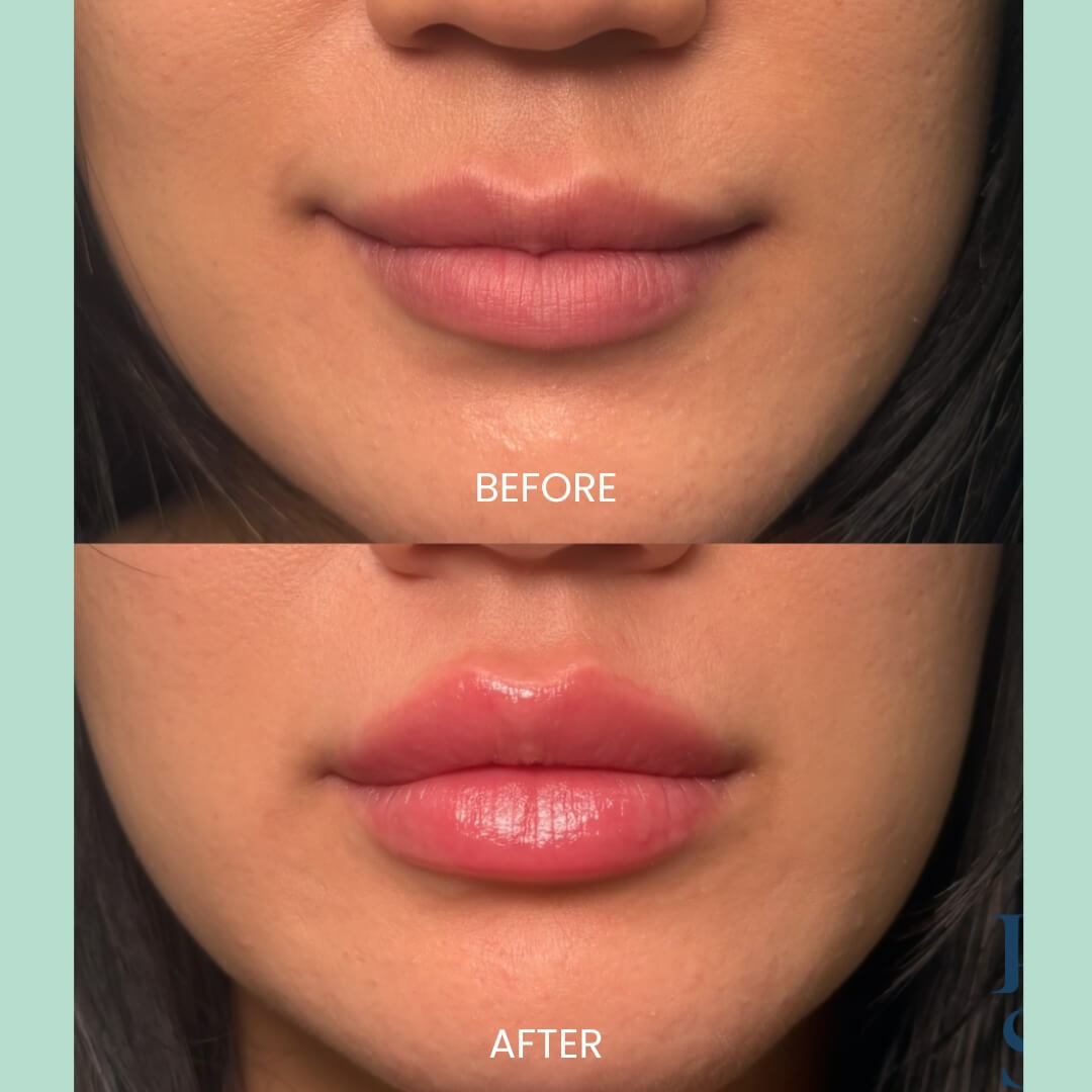Before and after image showcasing lip enhancement results. The top half displays the individual's natural lips before treatment, appearing subtle and less defined. The bottom half presents the same individual after the procedure, revealing fuller, more voluminous lips with a smooth, hydrated appearance. This transformation highlights the effectiveness of lip enhancement treatments in achieving a more defined and aesthetically pleasing lip shape. Ideal for those considering cosmetic procedures for lip enhancement, this image serves as a visual reference for potential results.