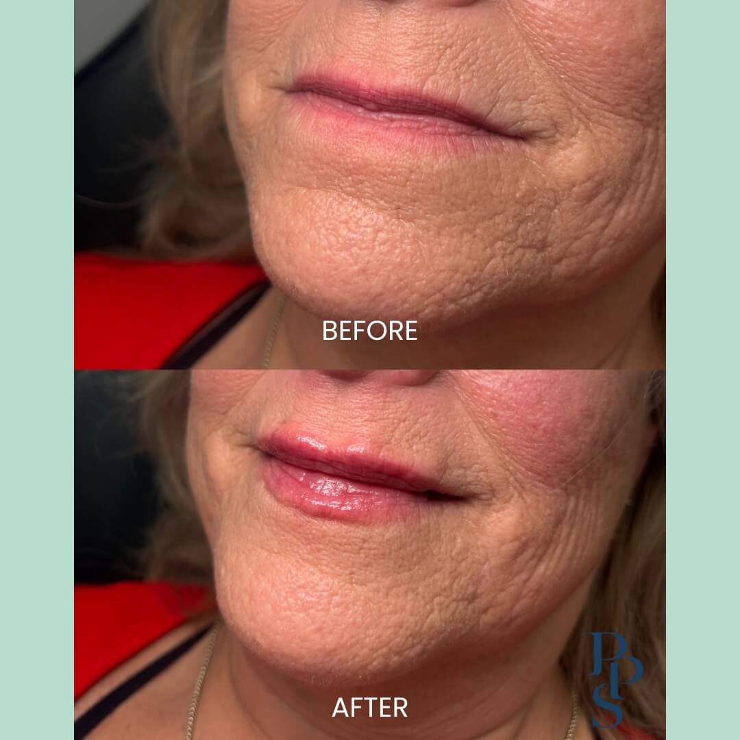 Image showing a side-by-side comparison of a woman's lips and chin area before and after a cosmetic treatment. The top half labeled "Before" shows visible wrinkles and uneven texture, while the bottom half labeled "After" displays smoother skin with reduced wrinkles and a more youthful appearance. The image highlights the effectiveness of the treatment in enhancing skin texture and overall facial aesthetics.