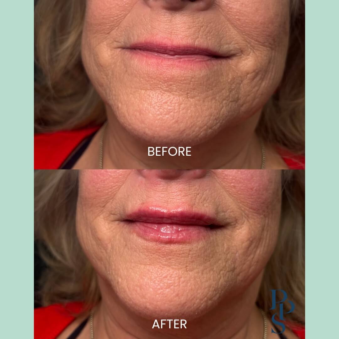Before and after image showcasing facial rejuvenation results. The top half displays the subject's mouth area with noticeable fine lines and dryness, labeled "Before." The bottom half shows the same area post-treatment, revealing smoother skin, enhanced lip volume, and a more youthful appearance, labeled "After." This transformation highlights the effectiveness of cosmetic procedures in reducing signs of aging and improving skin texture.